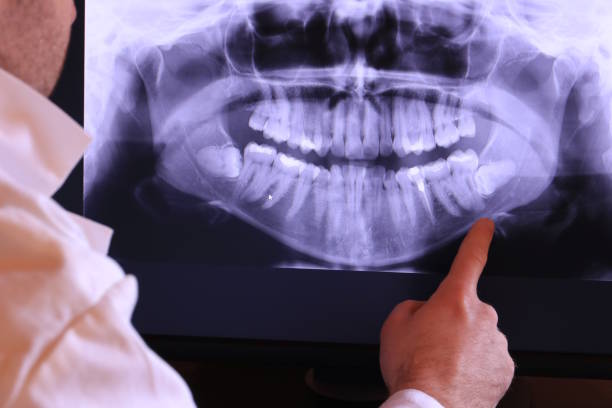Best Dentist for Tooth Abscess  in Ville Ptte, LA